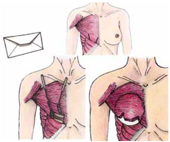 Mamoplastia de aumento: técnica em “aba de envelope” (ilustrações do artigo) - Figura 1 - Desenho esquemático da técnica "Aba de Envelope".