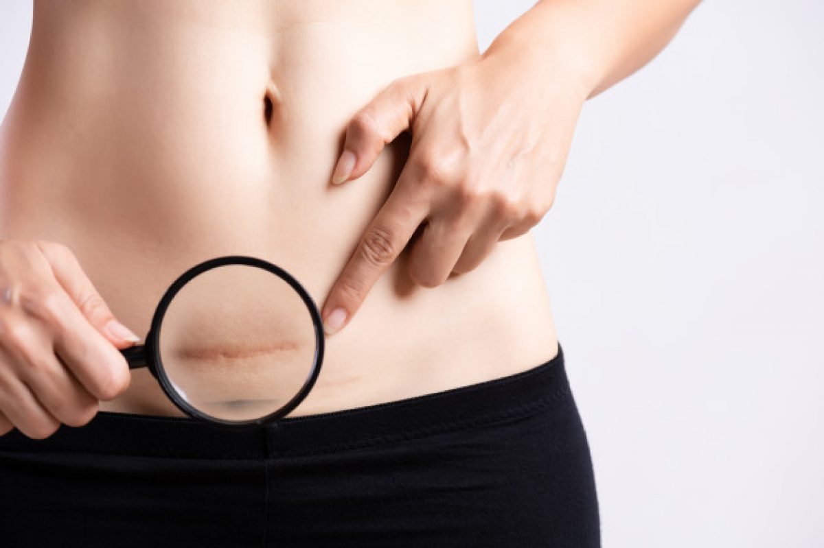 Endometriose na cicatriz da cesárea