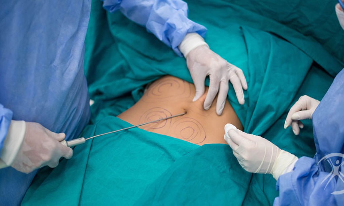 Lipoaspiração no abdome: 10 cuidados antes e depois da cirurgia plástica