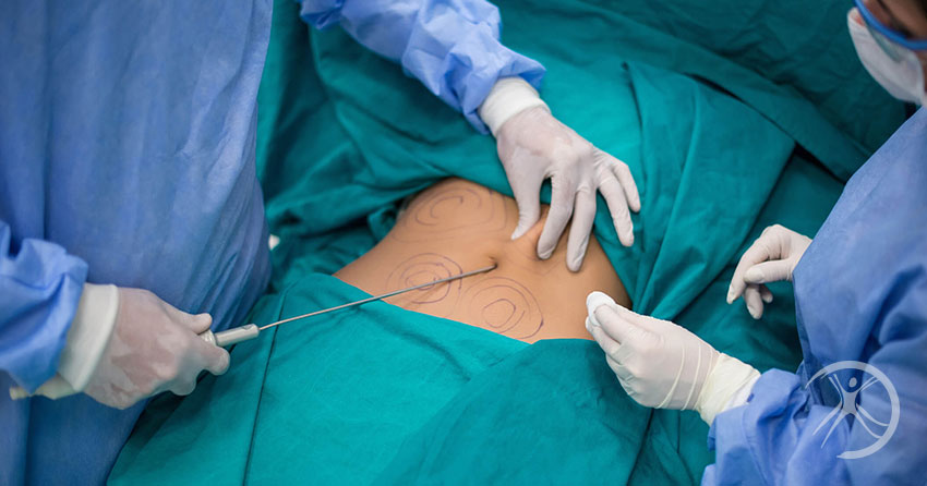 Lipoaspiração no abdome: 10 cuidados antes e depois da cirurgia