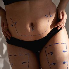 É seguro combinar cirurgias plásticas? Tudo o que você precisa saber