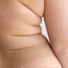 Gordura nos Flancos Entenda as Causas e as Soluções Estéticas da Flancoplastia
