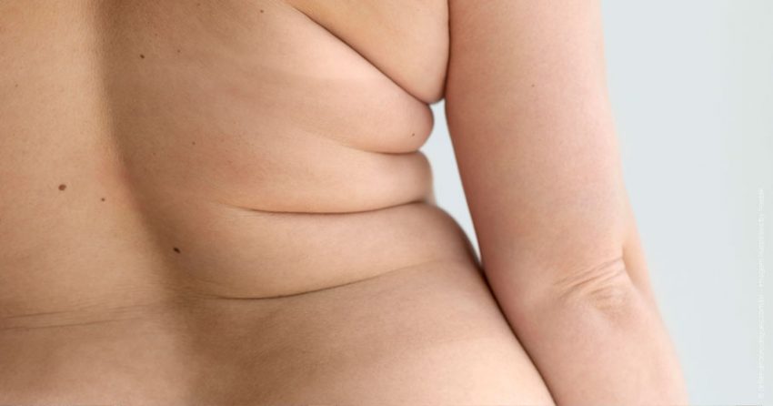Gordura nos Flancos: Entenda as Causas e as Soluções Estéticas da Flancoplastia
