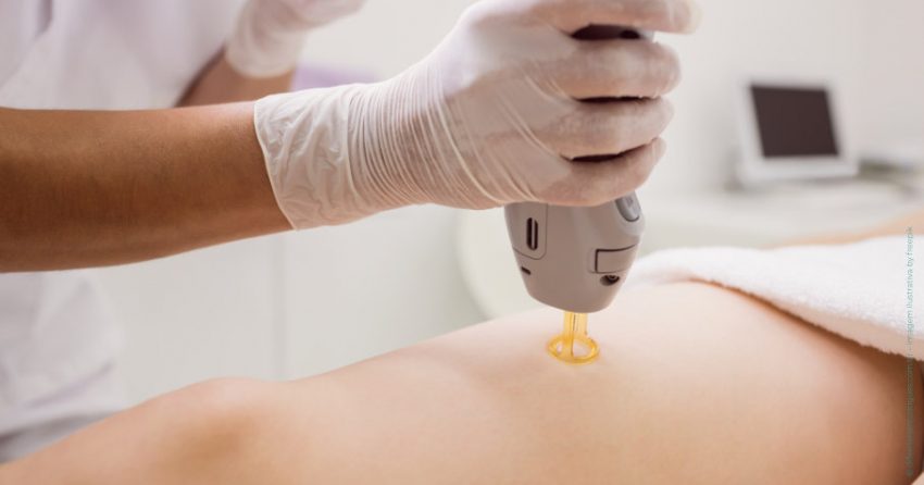 Laserterapia na Cirurgia Plástica: Um Guia Completo e Informativo